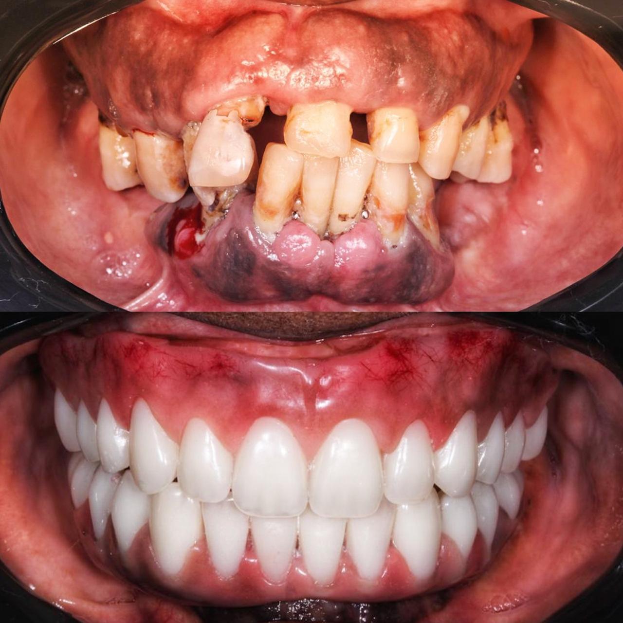Antes e depois de tratamento odontológico de paciente da Clínica Lotus