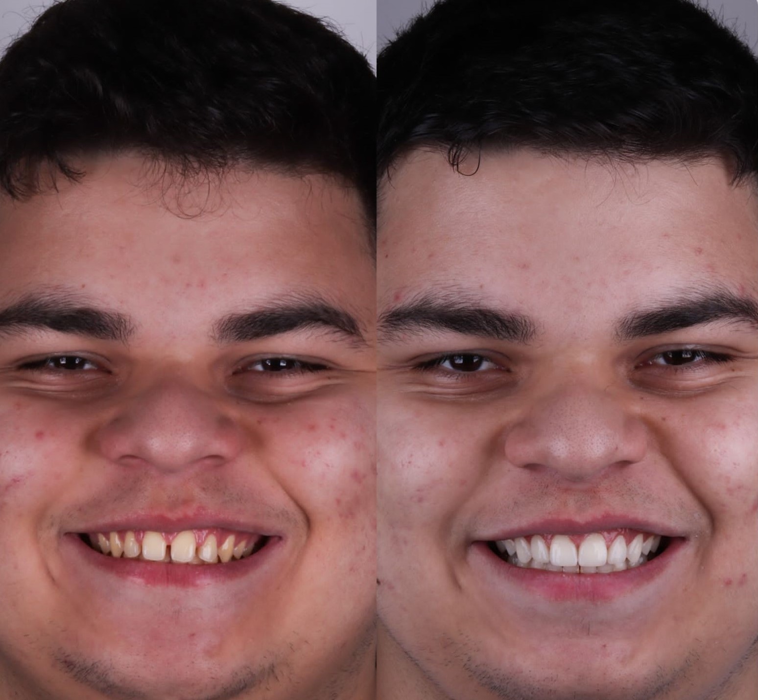 Antes e depois de tratamento estético odontológico de paciente da Clínica Lotus